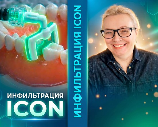 ICON – лечение начальных этапов развития кариеса методом инфильтрации