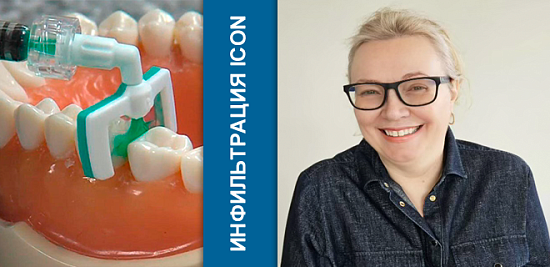 ICON – лечение начальных этапов развития кариеса методом инфильтрации